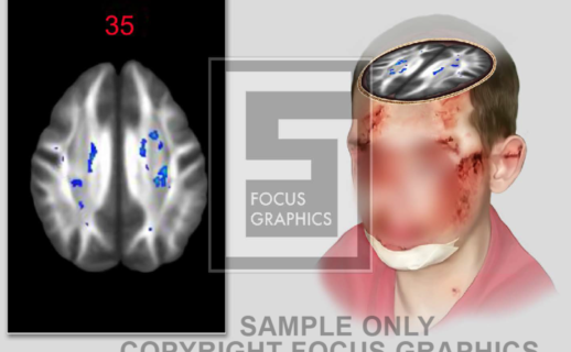 Brain MRI Scan shown on human