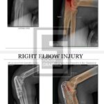 pre and post Xray of right elbow with colorization