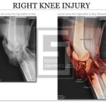 pre and post Xray of right knee with colorization