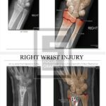 pre and post Xray of right wrist with colorization